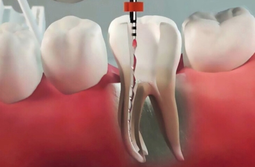 Ендодонтія лікування каналів Хмельницький